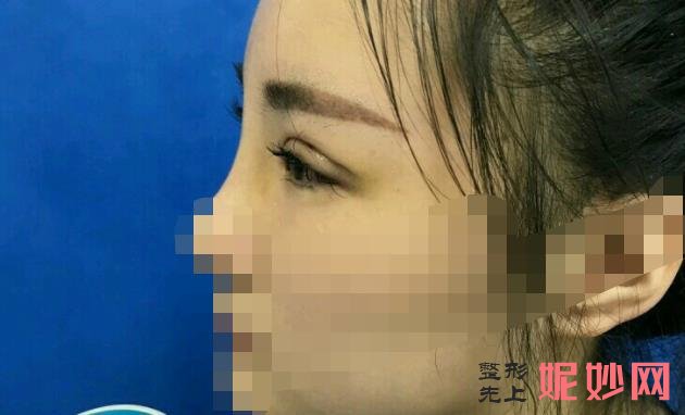 双眼皮修复刘学源和刘辅容哪个修复好？两位专家医生介绍，附案例和价格表！