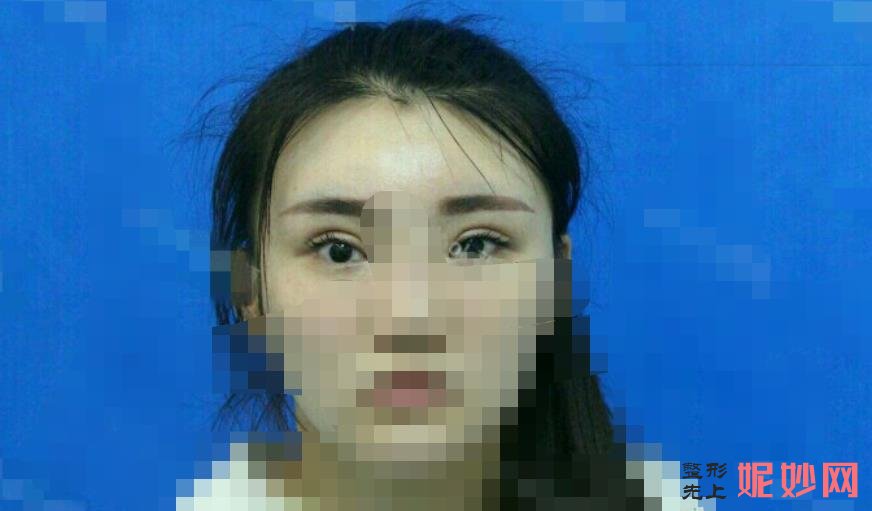 双眼皮修复刘学源和刘辅容哪个修复好？两位专家医生介绍，附案例和价格表！