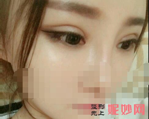 双眼皮修复刘学源和刘辅容哪个修复好？两位专家医生介绍，附案例和价格表！