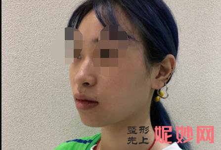 杨万忠和舒茂国谁鼻子做的好？两位医生的介绍，附案例分享和价格表！