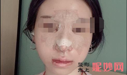 杨万忠和舒茂国谁鼻子做的好？两位医生的介绍，附案例分享和价格表！