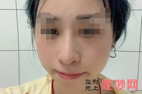 杨万忠和舒茂国谁鼻子做的好？两位医生的介绍，附案例分享和价格表！