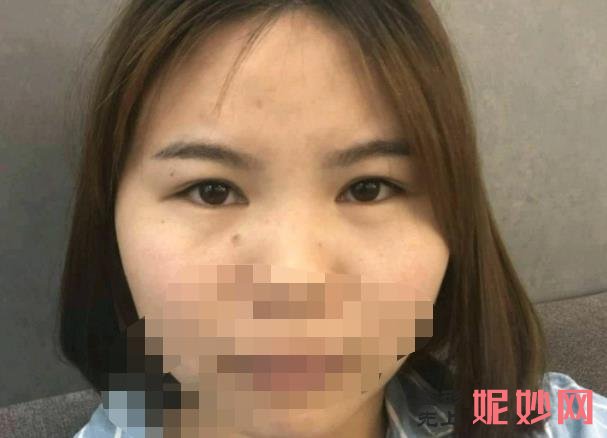重庆铂生医疗美容医院能做双眼皮吗？医院介绍附双眼皮案例和价格表！