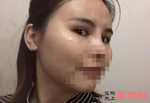 重庆铂生医疗美容医院能做双眼皮吗？医院介绍附双眼皮案例和价格表！