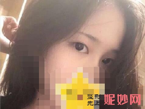 南京医科大学友谊整形外科医院好吗？能做双眼皮吗？附双眼皮案例和价格表！