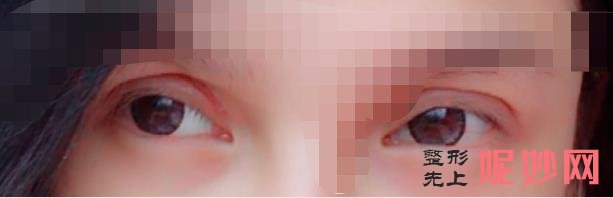 云南华美美莱整形医院是公立还是私立，做双眼皮修复行吗？附案例和价格表！