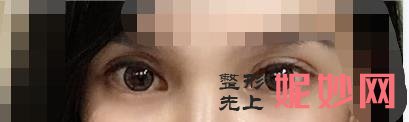 云南华美美莱整形医院是公立还是私立，做双眼皮修复行吗？附案例和价格表！