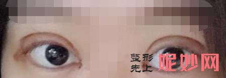 重庆五洲医疗美容医院做双眼皮技术好不好？附双眼皮案例和价格表！