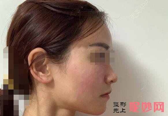 长沙爱思特医疗美容医院怎么样？能做激光祛皱吗？医院介绍妇激光祛皱案例和价格表！