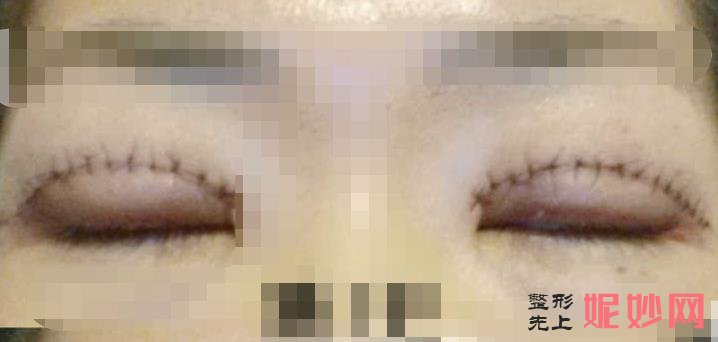 云南铜雀台美容医院做双眼皮好吗？附双眼皮案例和价格表！