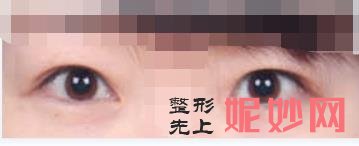 云南铜雀台美容医院做双眼皮好吗？附双眼皮案例和价格表！