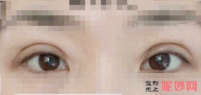 云南铜雀台美容医院做双眼皮好吗？附双眼皮案例和价格表！