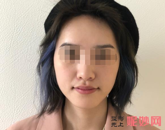西安画美医疗美容医院能做玻尿酸填充吗？附玻尿酸填充案例和价格表！