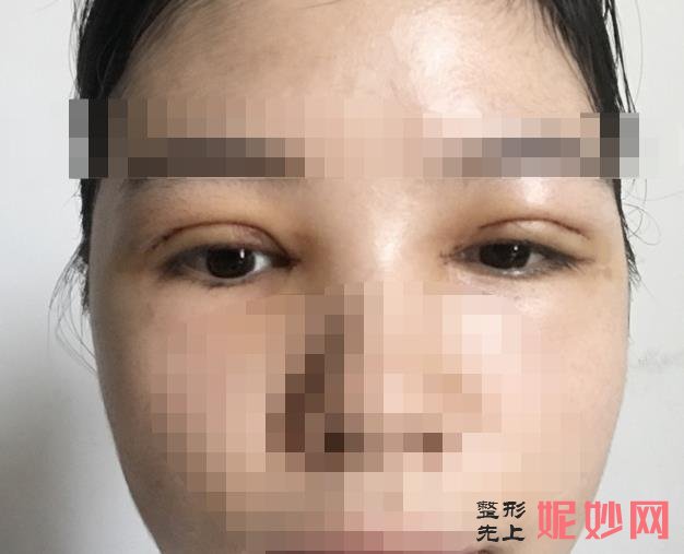 西安亚太医疗整形医院做双眼皮修复好吗？医院介绍附案例和价格表！