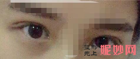 陕西省友谊医院整形外科做双眼皮好吗？附双眼皮案例和价格表！