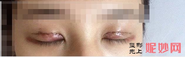 陕西省友谊医院整形外科做双眼皮好吗？附双眼皮案例和价格表！