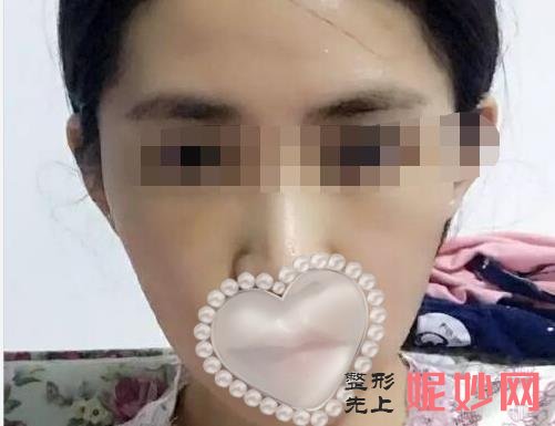 南宁星范医美整形医院做玻尿酸注射怎么样？医院介绍附玻尿酸注射案例和价格表！