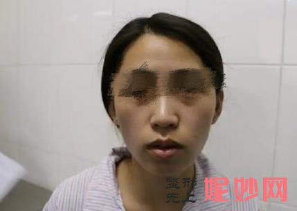南宁星范医美整形医院做玻尿酸注射怎么样？医院介绍附玻尿酸注射案例和价格表！