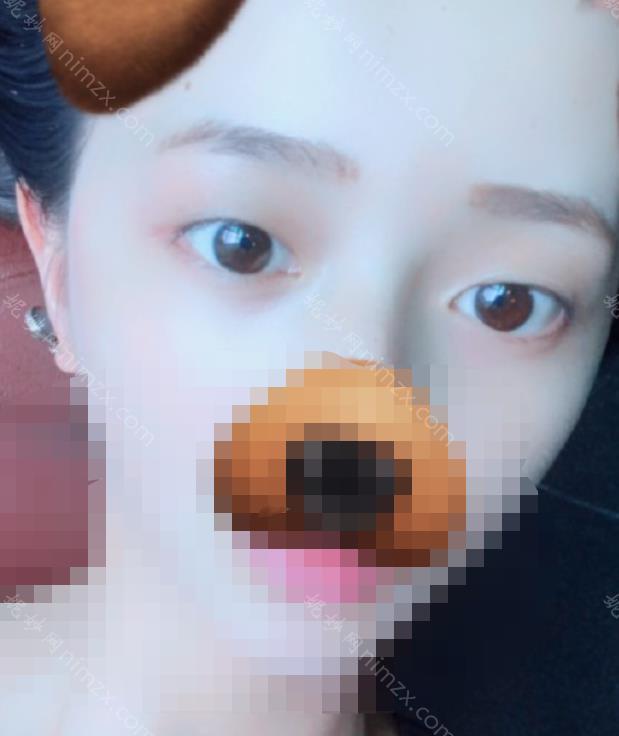 上海九院刘菲做的双眼皮好吗？有谁做过？院内眼部整形优质案例