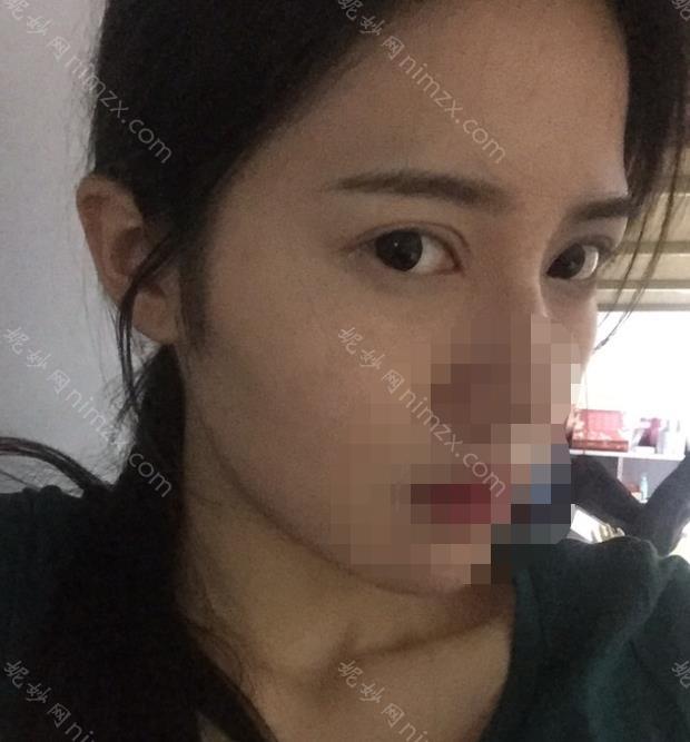 上海第九整形美容医院价格表分享给大家！金云波医生实操双眼皮效果图