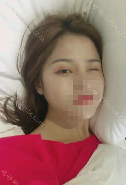 上海第九整形美容医院价格表分享给大家！金云波医生实操双眼皮效果图