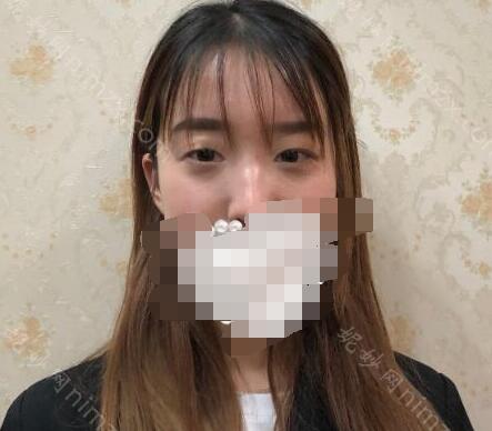 上海九院眼综合整形价目表2021揭晓！内附真人术后恢复图分享