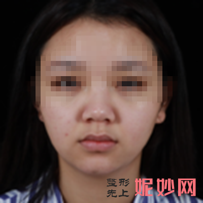 韦小勇医生做鼻子技术到底怎么样？_内附隆鼻案例分享_隆鼻价格表