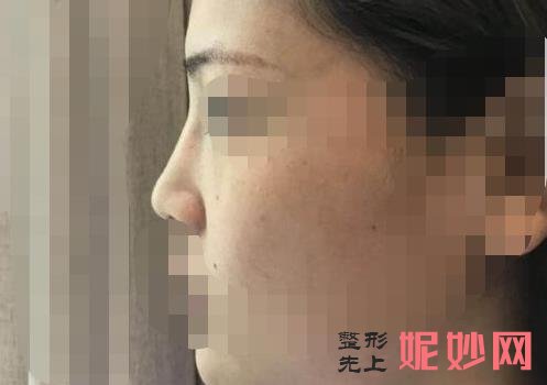 广州华美李文峰做鼻子技术评价怎么样？医生介绍附做鼻子案例和价格表！