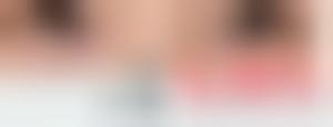郑州大学附属中心医院割双眼皮术后30天直观分享？