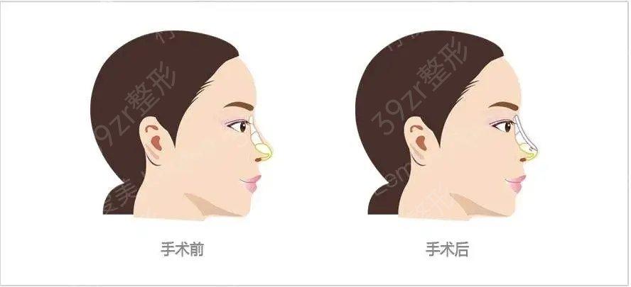 「广州广大整形美容医院柳超」怎么样?擅长|案例|价格表