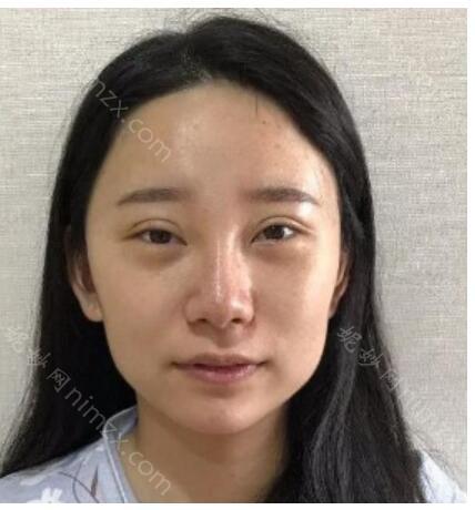 线雕和脂肪填充哪个好?附术后效果图分享_价格查询