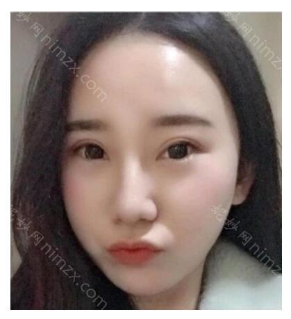 线雕和脂肪填充哪个好?附术后效果图分享_价格查询