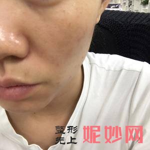 北京西美斯医疗美容诊所王凯医生技术好不好_下眼睑下至技术好不好