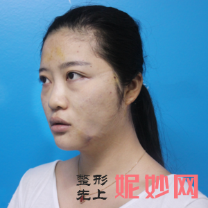 北京西美斯医疗美容诊所王凯医生技术好不好_下眼睑下至技术好不好