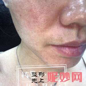北京西美斯医疗美容诊所王凯医生技术好不好_下眼睑下至技术好不好