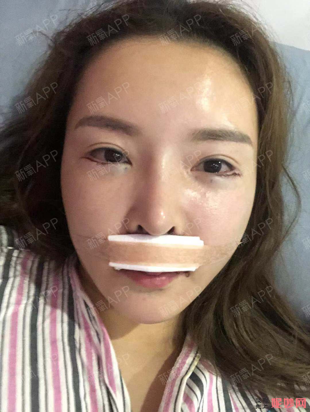 芜湖爱容整形医院谢小禹医生好不好_除皱针颏肌放松好不好_坐诊时间_案例分享