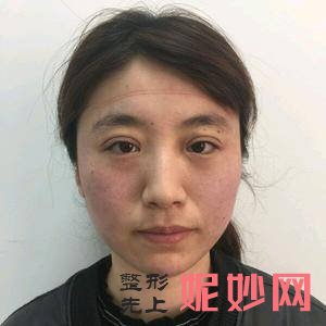 芜湖爱容整形医院谢小禹医生好不好_除皱针颏肌放松好不好_坐诊时间_案例分享