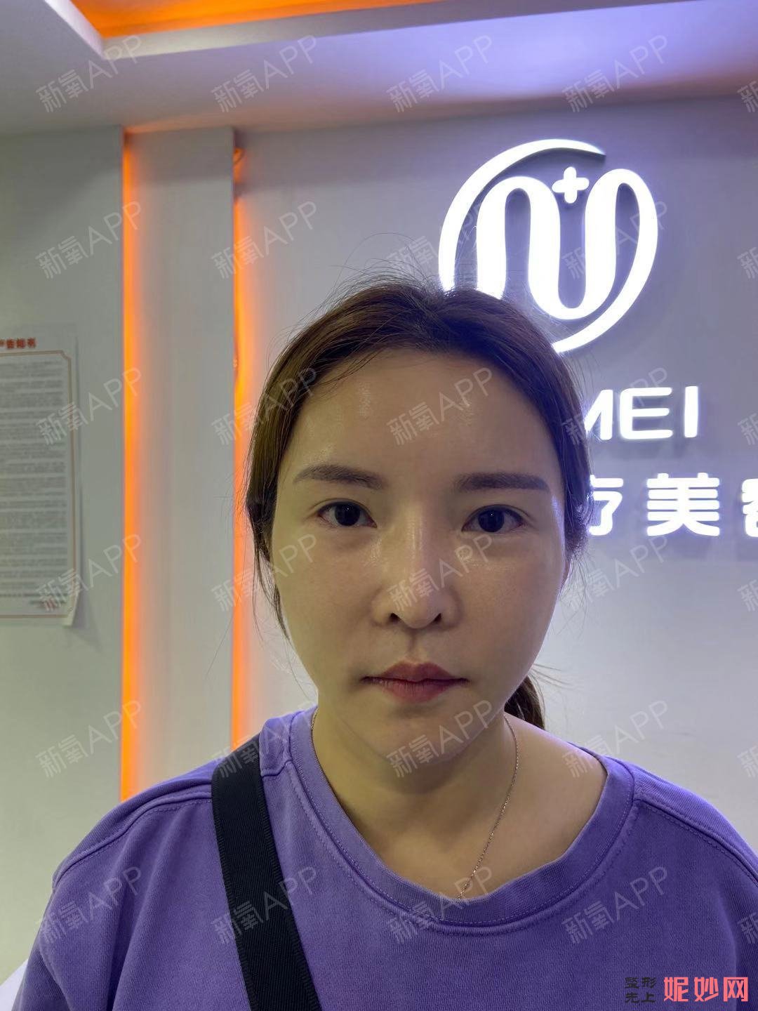 芜湖爱容整形医院谢小禹医生好不好_除皱针颏肌放松好不好_坐诊时间_案例分享