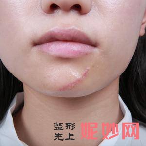 贵阳利美康整形外科医院陈娟医生靠谱吗_假体丰额头靠谱吗_出诊时间
