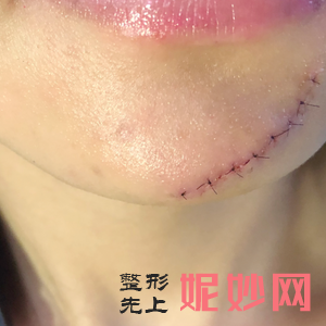 贵阳利美康整形外科医院陈娟医生靠谱吗_假体丰额头靠谱吗_出诊时间