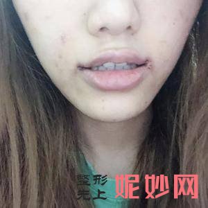 北京薇琳医疗美容医院董香君医生好不好_乳头内陷矫正好不好_坐诊时间_案例分享