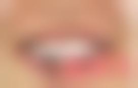 郑州唯美口腔门诊部王富来做隐形矫正技术好吗？附案例和价格表！