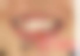 郑州唯美口腔门诊部王富来做隐形矫正技术好吗？附案例和价格表！