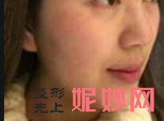 先做m22还是热玛吉？术后的效果怎么样？