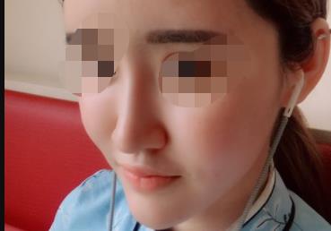 m22光子嫩肤多久做一次？m22光子嫩肤效果能持续多久，附案例！