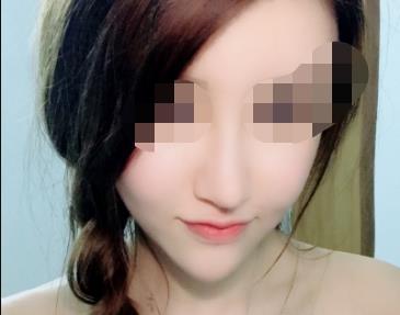 m22光子嫩肤多久做一次？m22光子嫩肤效果能持续多久，附案例！