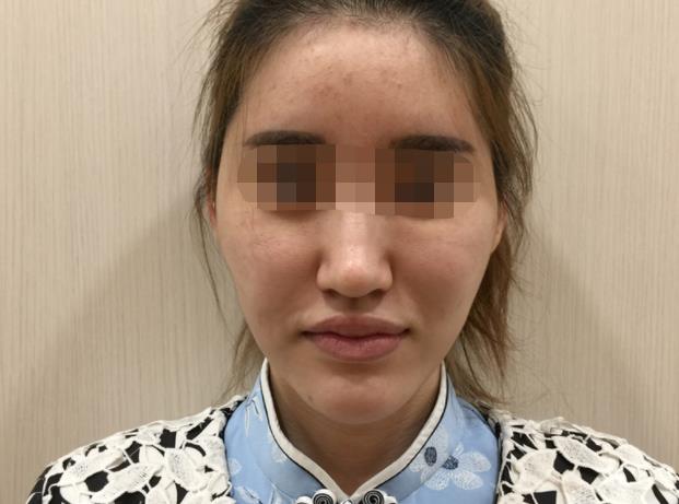 m22光子嫩肤多久做一次？m22光子嫩肤效果能持续多久，附案例！