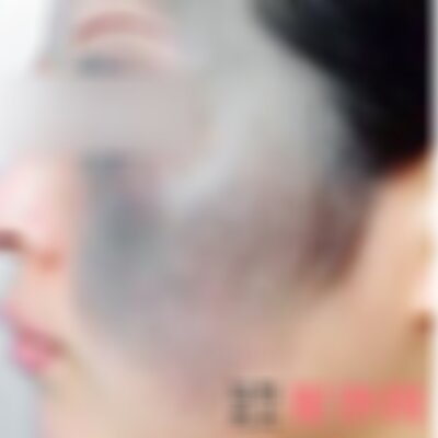 南京华美去胎记效果好吗