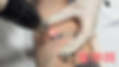南京华美整形医院可以洗纹身吗