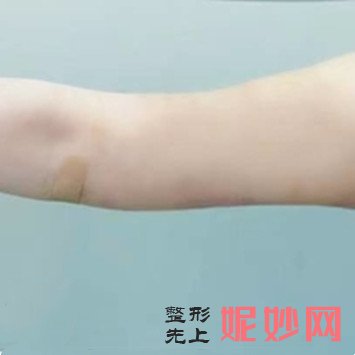南京华美手臂抽脂多少钱